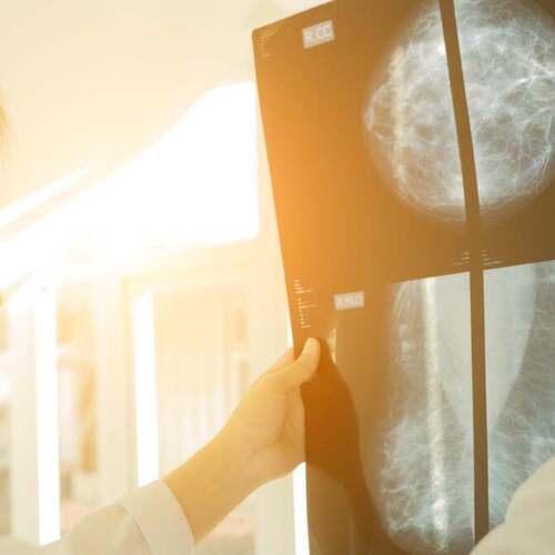 Why It Matters If You Have ‘Dense’ Breast Tissue